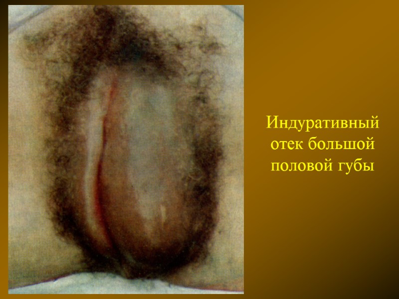 Индуративный отек большой половой губы